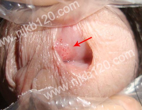 男性尿道口尖锐湿疣症状图片