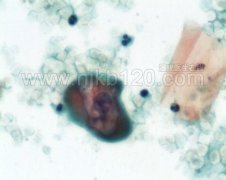 宫颈液基可见典型挖空细胞图片