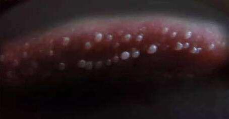 尖锐湿疣初期与珍珠疹如何区分